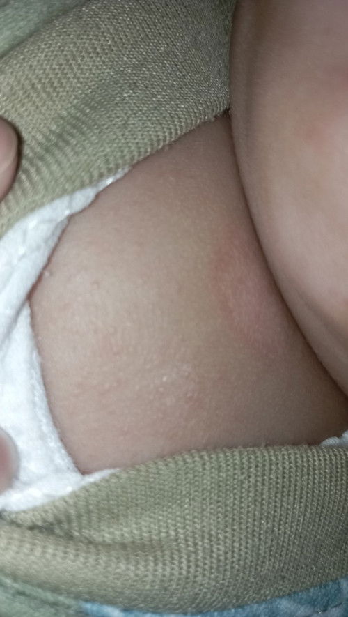 mau tanya dong ini tuh knapa ya apa biang keringat ,sama cara menghilangkannya pakai apa ya