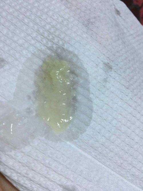 Mucus plug?