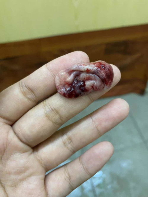 Kantung atau gumpalan darah saja?