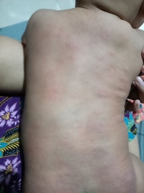 Gatal" pada anak di usia 4bln