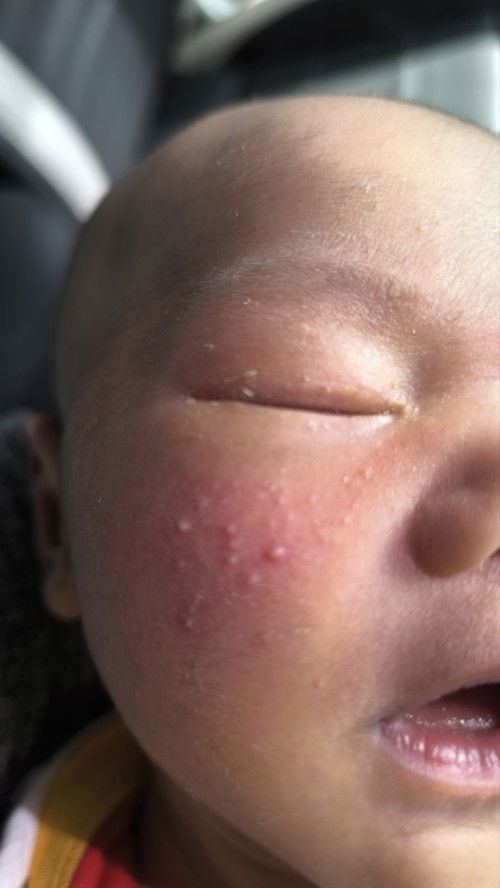 Pipi baby berbiji seperti jerawat