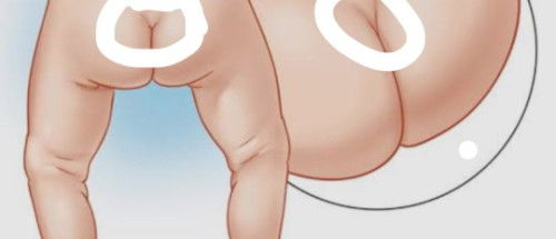 Question tungkol sa linya ng pwet