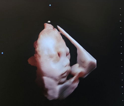 ตอนนี้น้องได้28Week1dayแล้วค่ะ