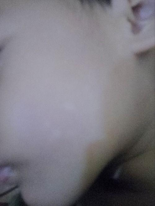 Bercak putih dipipi anak.