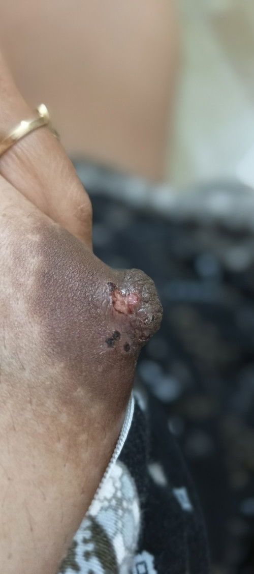 puting kering ngelupas saat hamil