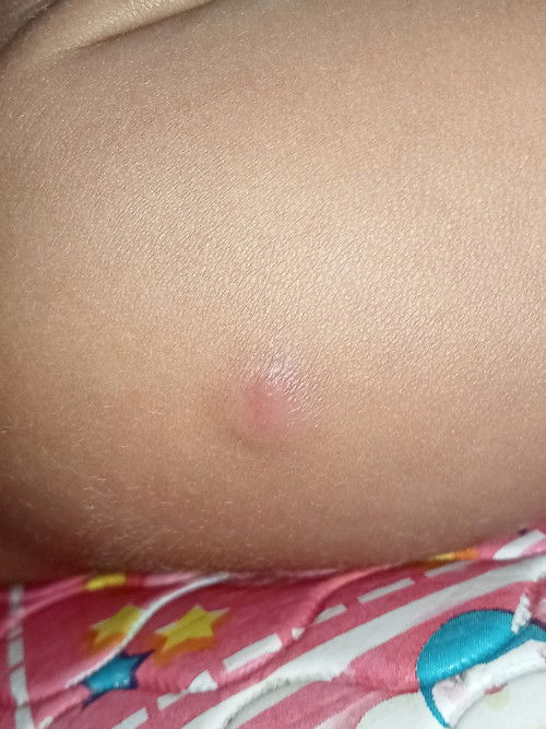 Benjolan lengan tangan kanan