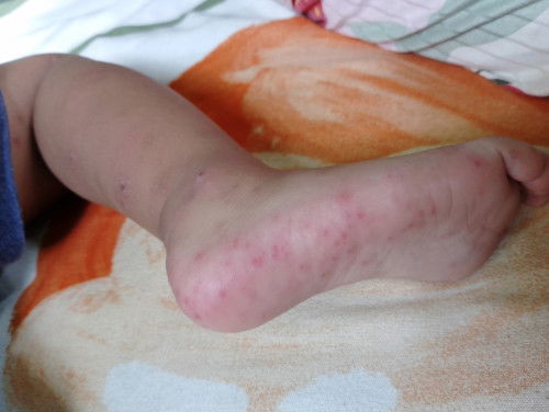 Hand Foot and mouth disease