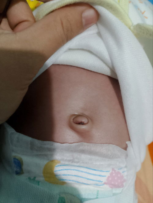 Mau tanya Bun , pusar bayi seperti ini bodong atau tidak ya?