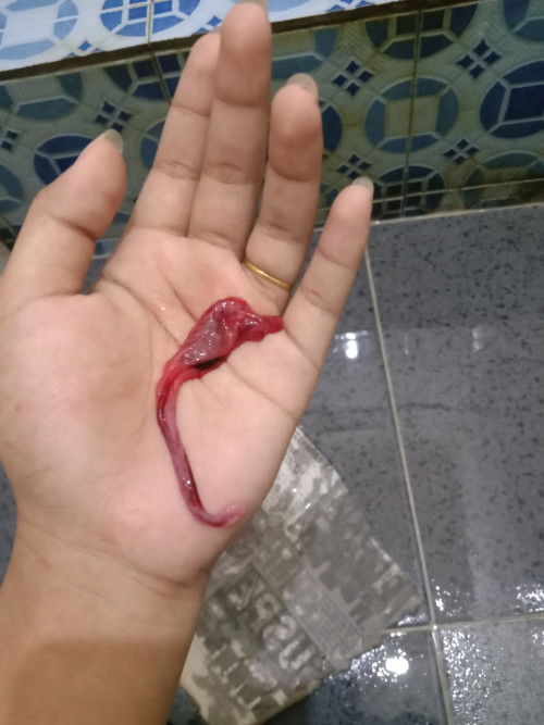 Apakah ini semacam janin atau bukan sata telat satu Minggu lebih @???