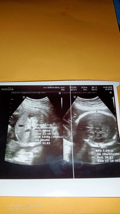 Bagi tipsnya dong bun agar bayi tidak sungsang lagi, sya bru sja semalam hbis usg di usia 30w