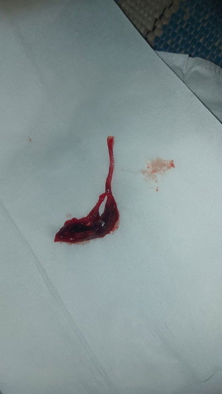Garis 2 tpi flek
