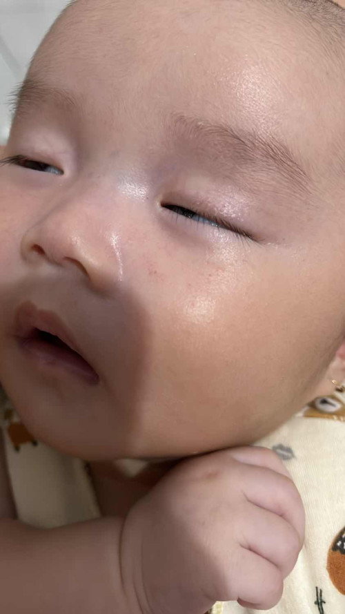 Kenapa ya muka anak ku seperti berdarah tetapi di bawah kulit?