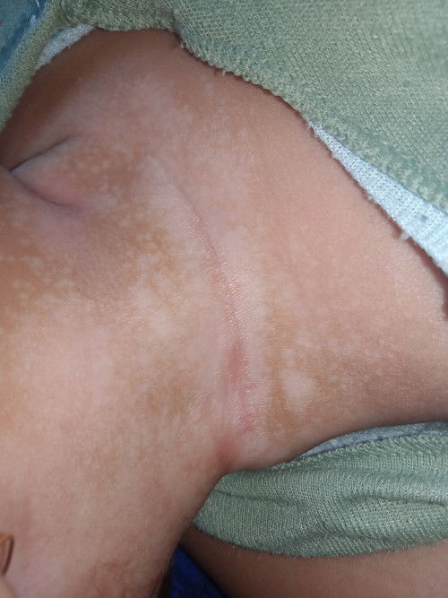 Ruam merah di leher berubah jadi putih