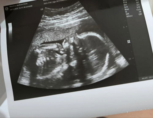 Normal kaya ang lipt and nose ni baby?