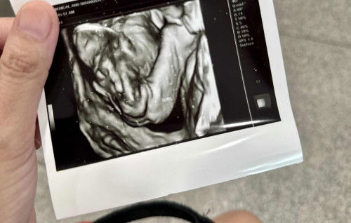 Baby Gender