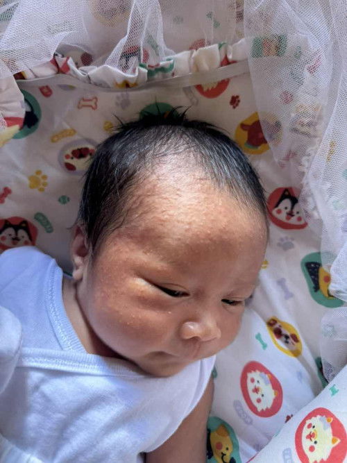 Red bumps at forehead and cheeks