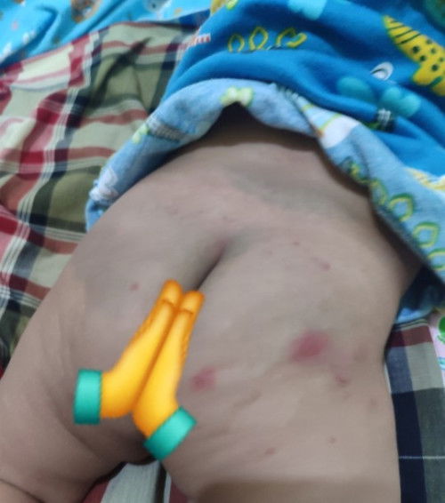 Alergi atau ruam popok?