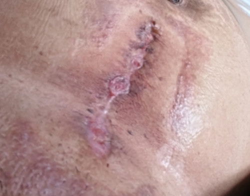 CS Incision