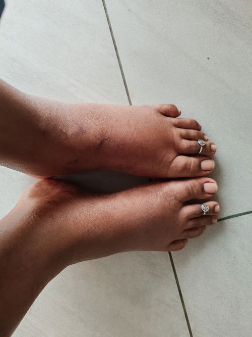 Now I'm 20 week pregnant, suddenly my foot is swallon. Yyy?