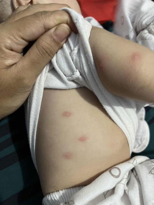 Merah merah pada anak