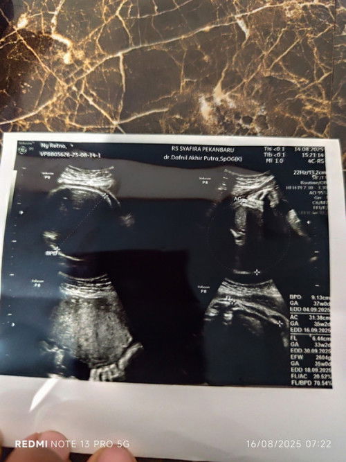 SC di usia kandungan 37 weeks lebih 1 hari