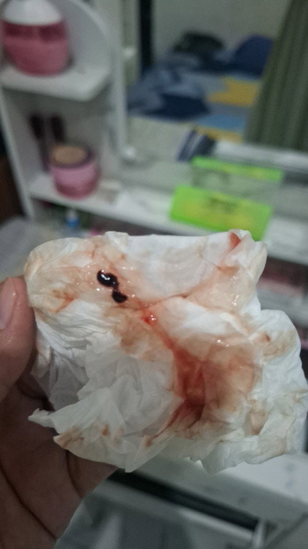 Keluar lendir darah