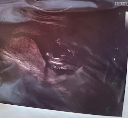 Gender baby