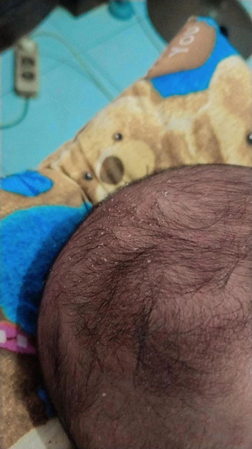 Seperti ketombe/kerak