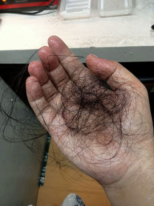 แม่ๆบ้านไหนหลังคลอดผมร่วงบ้างค่ะบ้านนี้ร่วงทีละกำมือเครียดมากค่ะ