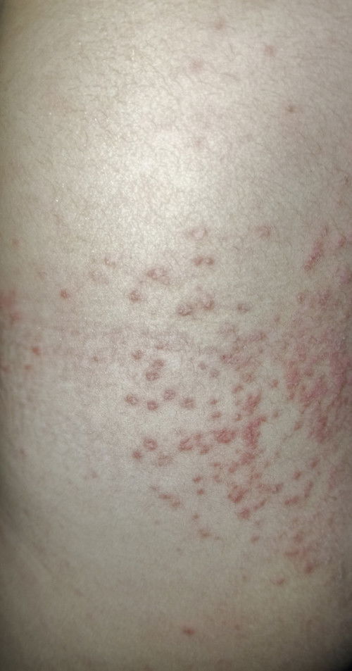 Rashes po ba ito?