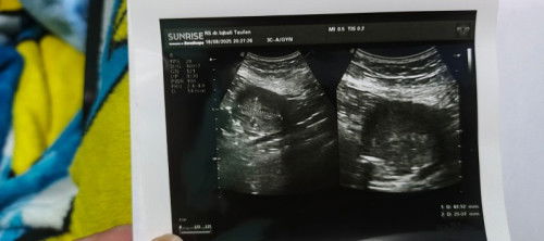Perhitungan sesuai hpht baru 4w5d, pas USG apa ada yg hanya penebalan dinding rahim?