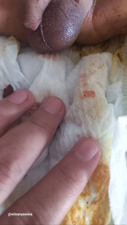 Bun ada bercak darah di popok bayi laki-laki usia 4 hari aman gak ya?.