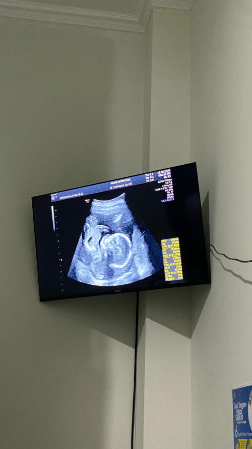 Hasil usg alhamdulillah sehat dan lengkap cuman di sarananin kurangi konsumsi gula.