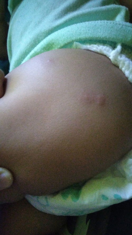 Alergi pada bayi mpasi