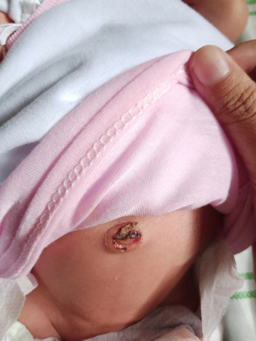 Mga mii normal lang ba na matagal maghilom pusod Ng baby ? Eto kc pusod Ng baby ko 23 days na siya