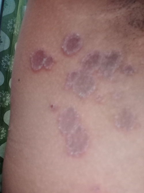 Gatal pada usia kehamilan 11week