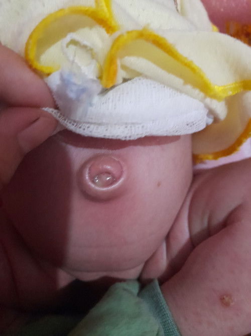 Anak rewel gara² puser nya berair dan seperti ada bendolan