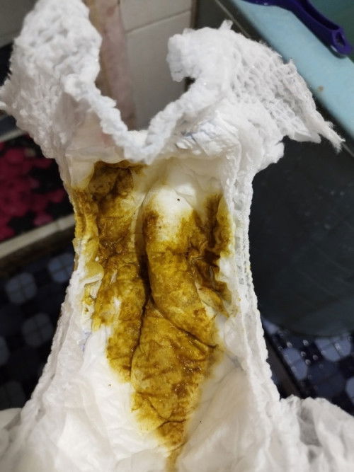 Bun help, bayi ku umur 10 bln pup nya gini normal ga ya? Padahal dulu pas umur 7-8 an smpt agak pdat