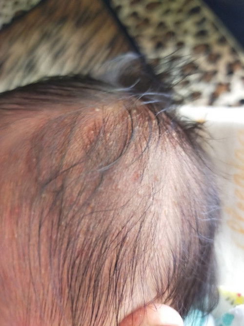 Kulit kepala newborn bruntusan kecil seperti berair
