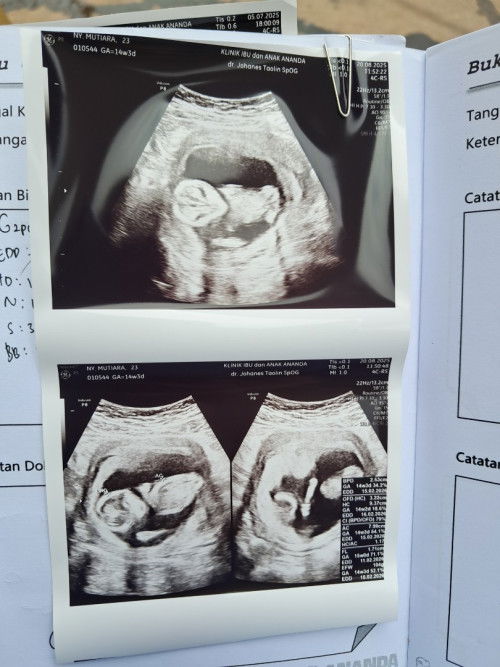 Flek di usia 14week