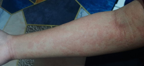 Bumil TM3 mengalami ruam gatal seluruh badan