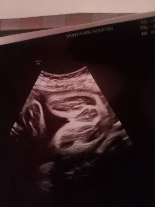 30weekแล้ว