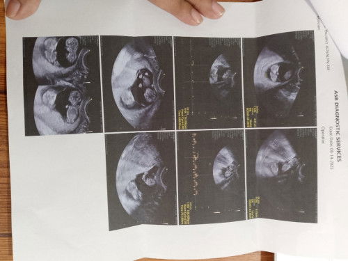 kambal ang aking baby, at nasa isang placenta lang sila, bigyan mo ako ng tips na mga dapat gawin,ty