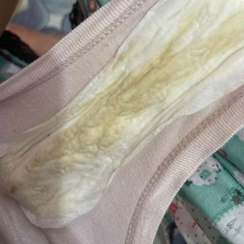 Hi mga mami may nalabas sakin yellow discharge at may amoy sya ano kaya pwedeng gawin? 33 weeks preg