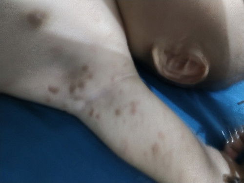 Kulit merah2 melenting dan udahannya biru ada bekasnya knpa yahh? Ada info ga bun??
