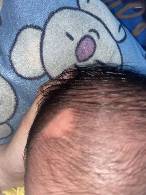 Pitak bintik-bintik pada kepala bayi