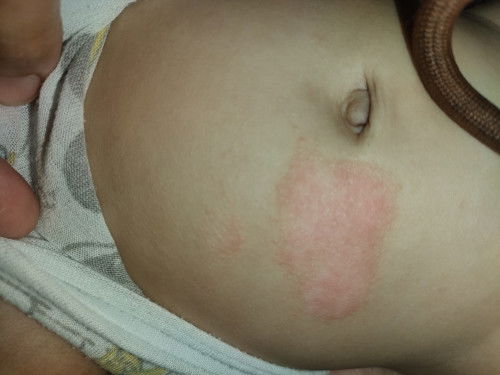 How to cure to this one po?
Is this eczema?