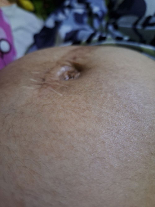 Mau tanya bun di sini ad ndk yg pnya riwayat op usus buntut pecah dan hamil tpi sakit nya luar biasa
