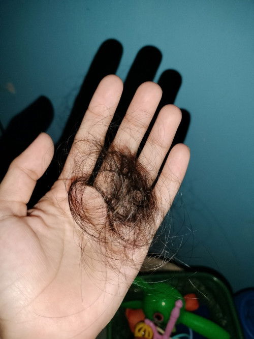 Rambut rontok parah