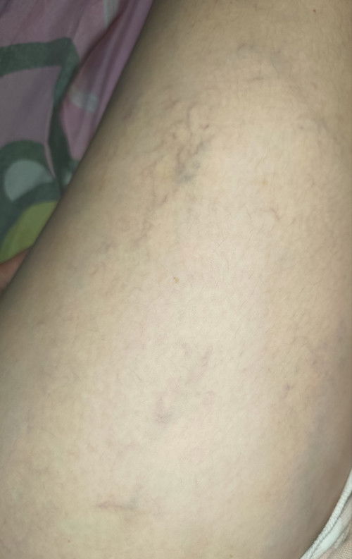 Mga mhie paano kaya macontrol pagdami ng varicose ko?7 months pregnant po ako ngaun . bigla lumabas